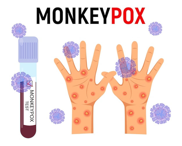 Monkey pox background a test tube with blood for a test and a human hand with a rash and ulcers