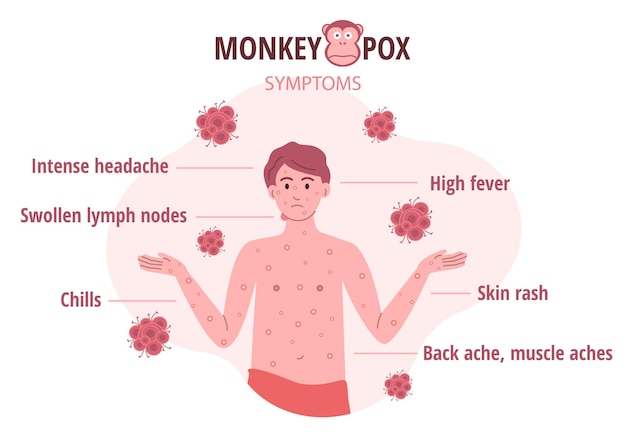 Monkey pox outbreak Infographics of virus symptoms in humans Vector illustration