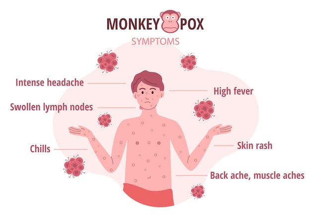 원숭이 수두 발병 인간의 벡터 일러스트 레이 션에서 바이러스 증상의 인포 그래픽