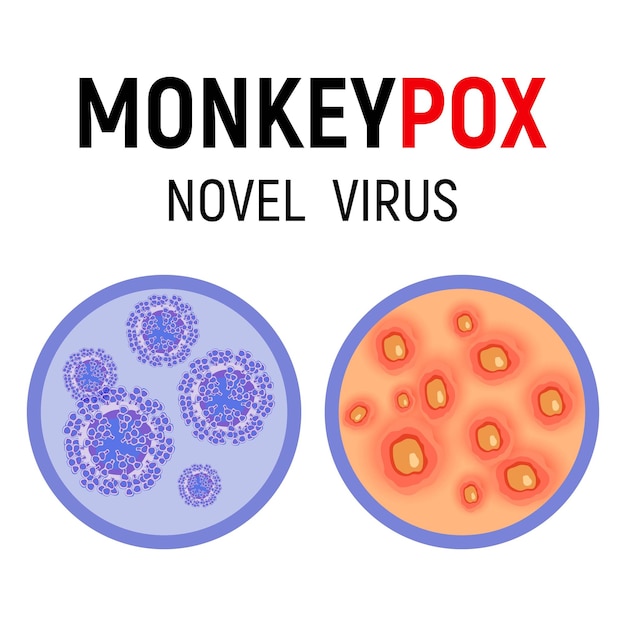 Monkeypox virus cells and human skin with rash wounds and ulcers on a white background closeup