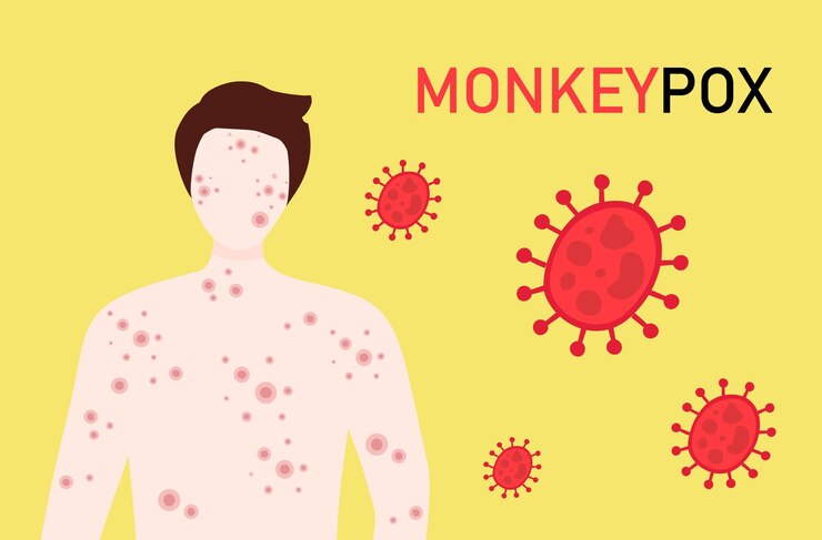 Vector 원숭이 수두 바이러스 개념 남자 전신에 발진으로 고통받는 새로운 orthopox 바이러스 발병 전염병