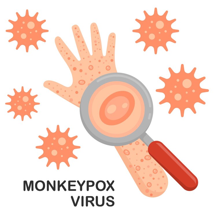 Vector 손과 팔에 있는 monkeypox 바이러스
