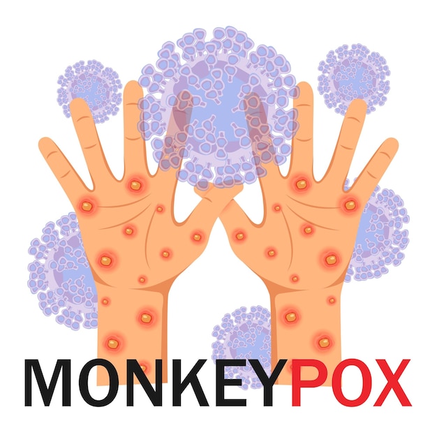 Monkeypox virus human hands with a rash on a microbiological background with text monkeypox concep