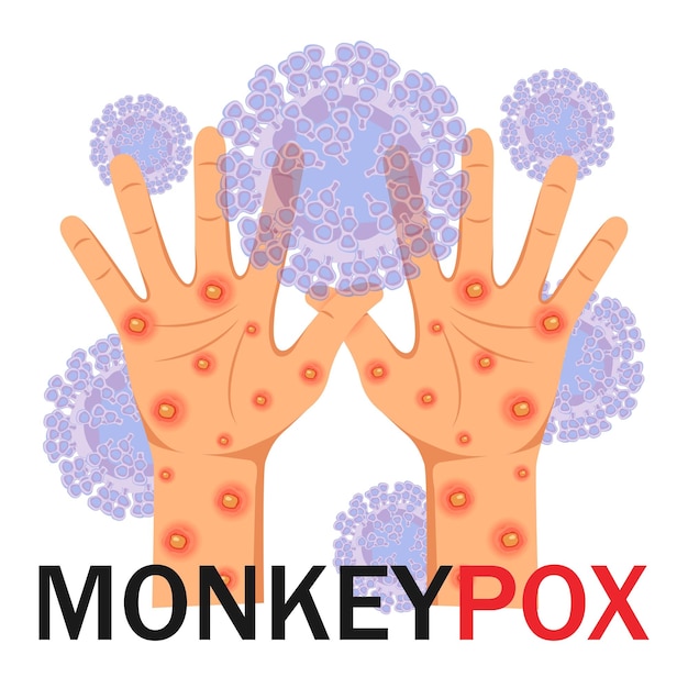 Monkeypox virus Menselijke handen met uitslag op een microbiologische achtergrond met tekst Monkeypox concep