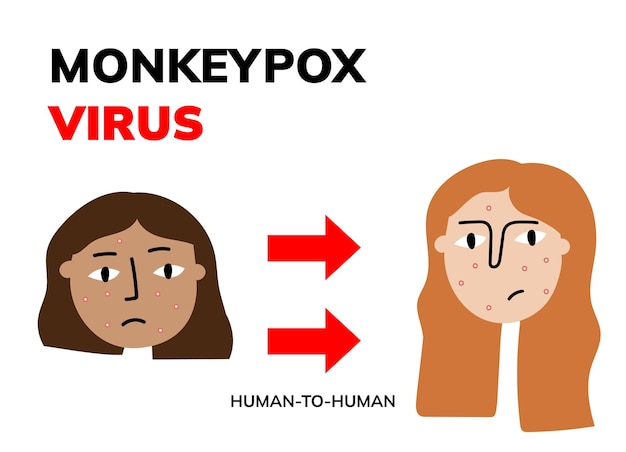 Virus monkeypox donne tristi con eruzioni cutanee e scimmia illustrazione piatta illustrazione medica concep