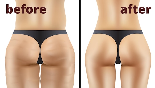 Vector morbid obesity liposuction before and after illustration