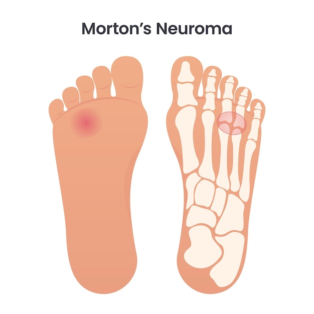 Vector morton's neuroma medical educational vector illustration graphic