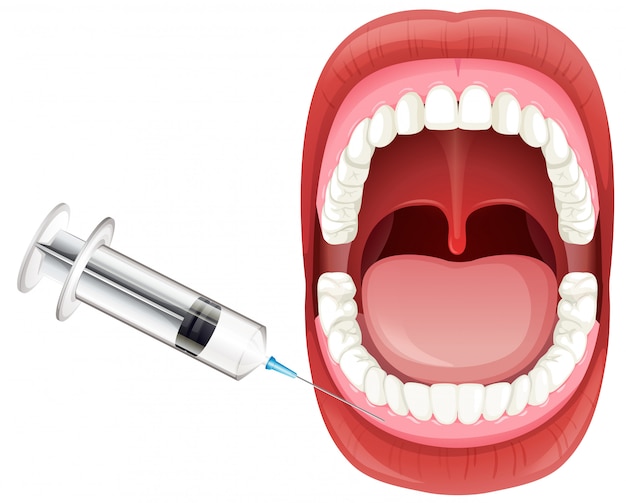 Mouth anatomy showing gum injection