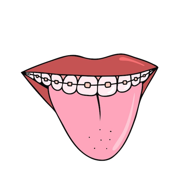 Mouth with tongue braces hand drawn illustration