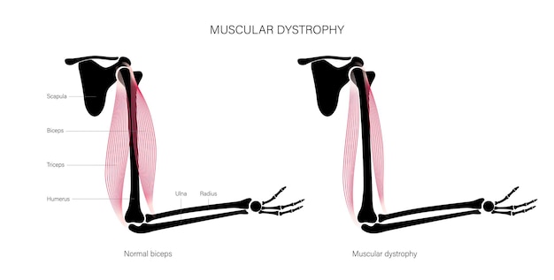 Muscular dystrophy of arm