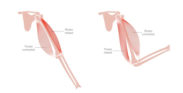 Muscular dystrophy of arm