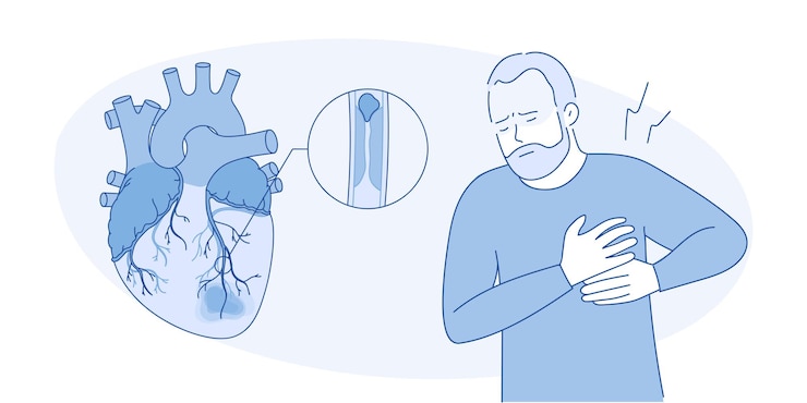 Vector myocardial infarction illustration of a human heart heart attack illustration in cartoon style