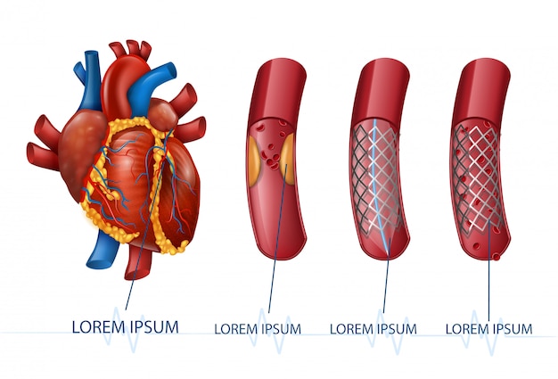 Vettore infarto miocardico