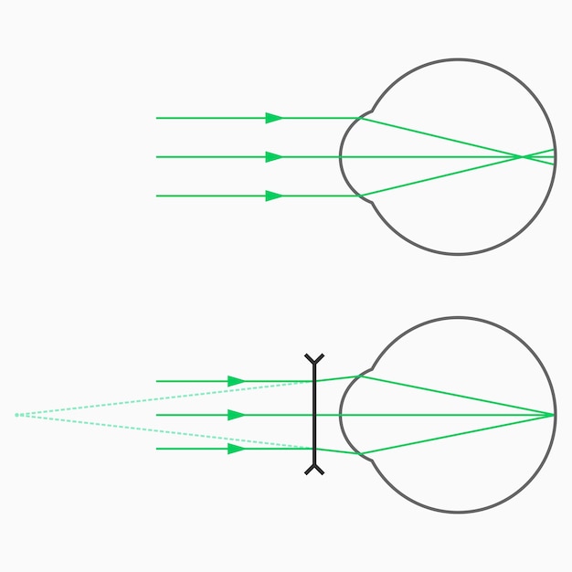 Vector myopia (nearsightedness) and myopia correction with glasses