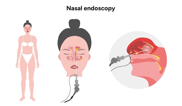 nasal endoscopy procedure nasal and sinus passages flexible tube with camera and light