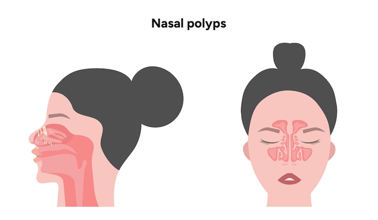 Vector nasal endoscopy procedure nasal and sinus passages thin flexible tube with camera and light
