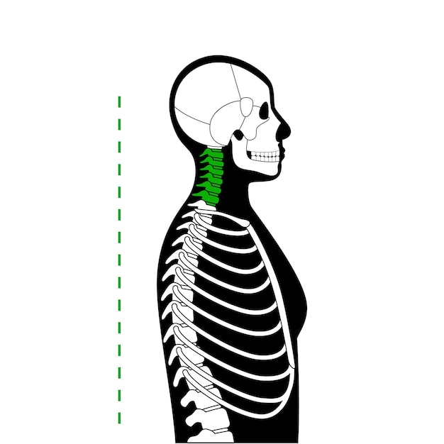 Vector neck vertebrae deformity