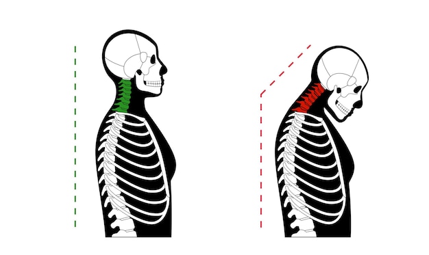 Vettore deformità delle vertebre del collo