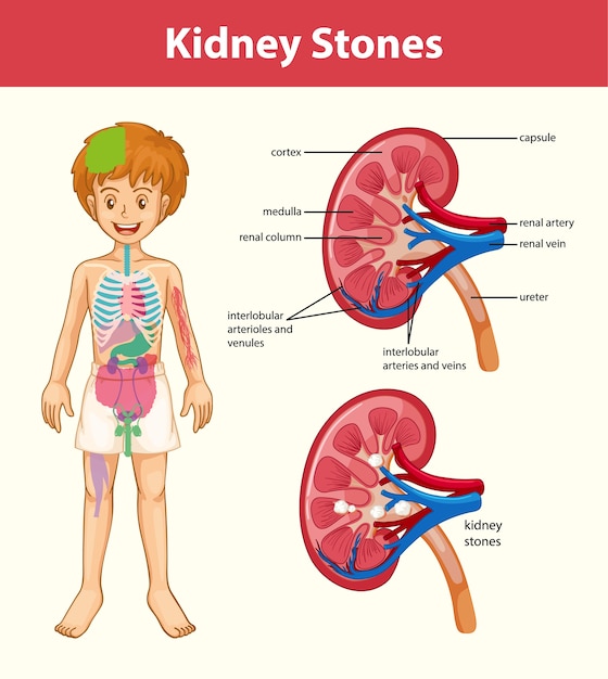 Nierstenen symptomen cartoon stijl infographic