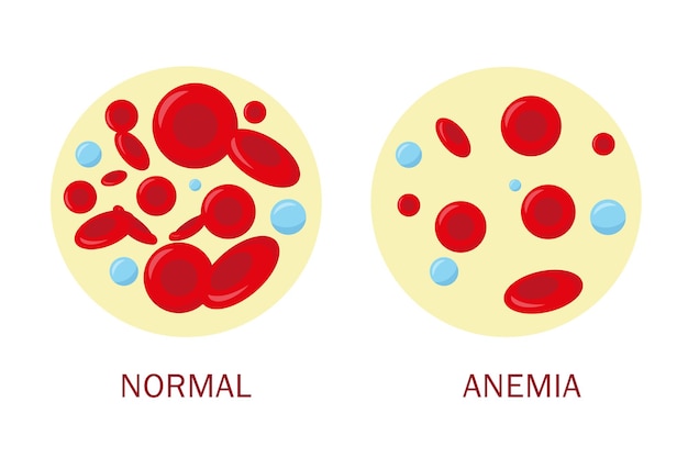 Cellule del sangue nolmal e cellule del sangue di anemia. concetto medico.