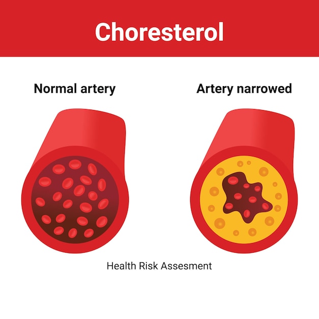 Vector normaal bloedvat versus slagader met cholesterolplaque