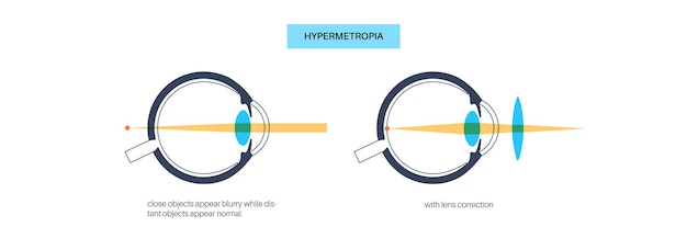 Vector normaal oog en verzicht