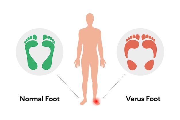Вектор Нормальная и варусная нога
