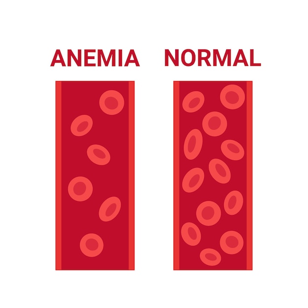 정상, 빈혈 혈액 내 혈관 비교 수 순환 세포 적혈구. 빈혈 혈액 세포