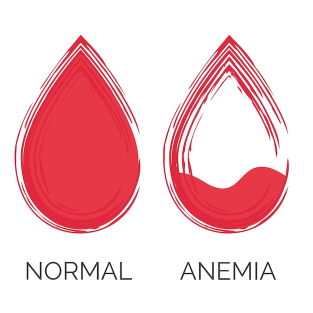 Goccia di sangue normale e anemica. mancanza di globuli rossi, anemia. isolato su sfondo bianco.