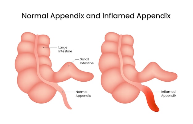 normal appendix and inflamed appendix