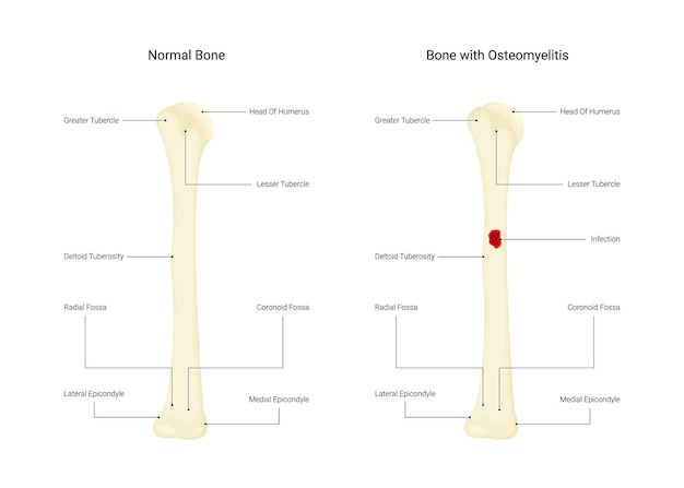 Vector normal bone and bone with osteomyelitis