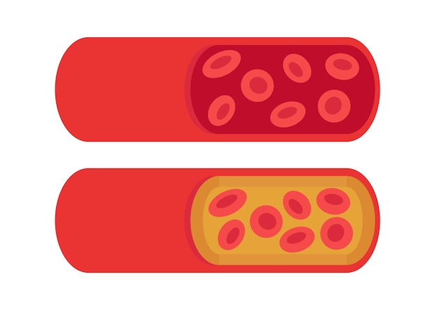 Normal and cholesterol blocked artery blood clot thrombus atherosclerotic plaque vein thrombosis