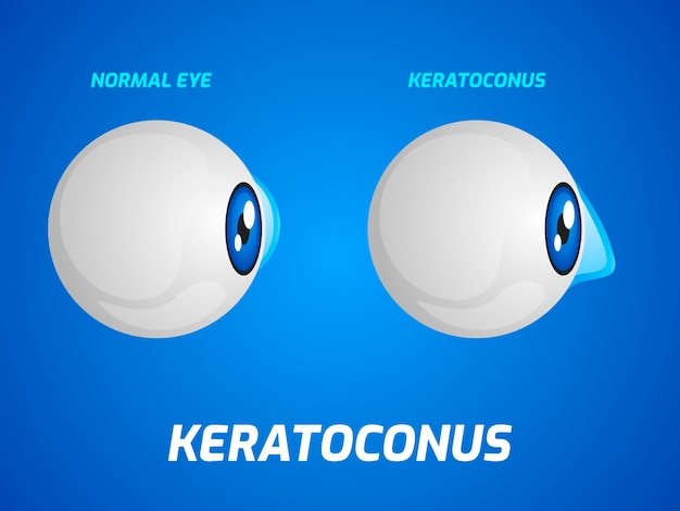 Нормальный глаз и концепция кератоконуса. векторная иллюстрация.