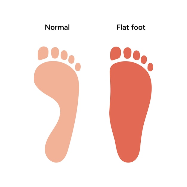 Vector normal and flat foot