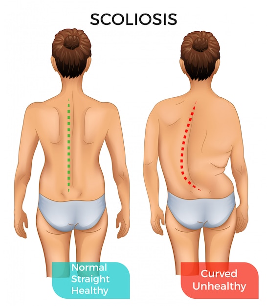 Вектор Нормальный здоровый позвоночник и изогнутый позвоночник со сколиозом