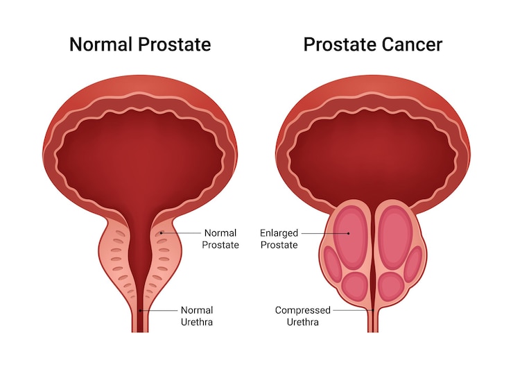 Vector normal prostate and prostate cancer inflammation
