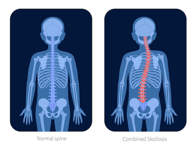 Normal spine and combined scoliosis in boy body. XRay flat vector illustration. Backbone, joint and skeleton anatomy in child silhouette. Orthopedic poster. Medical banner. Exam in spinal pain center.