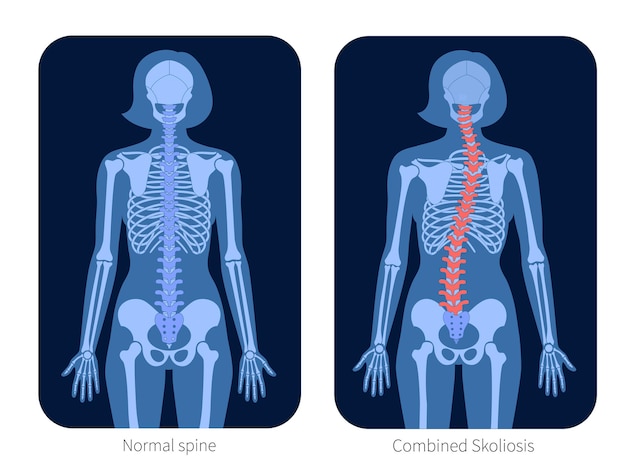 Normal spine and combined scoliosis in woman body. XRay flat vector illustration. Backbone and skeleton anatomy in female silhouette. Orthopedic poster. Medical banner. Exam in spinal pain center