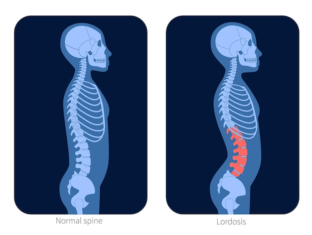 Normal spine and lordosis in child body. XRay flat vector illustration. Backbone and skeleton anatomy in boy silhouette. Orthopedic poster. Medical banner for clinic. Exam in spinal pain center