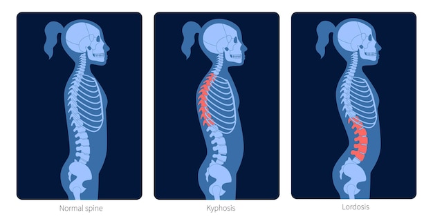 Normal spine, lordosis and kyphosis. Scoliosis in child body. XRay flat vector illustration. Backbone and skeleton anatomy in girl silhouette. Orthopedic poster. Medical exam in spinal pain center