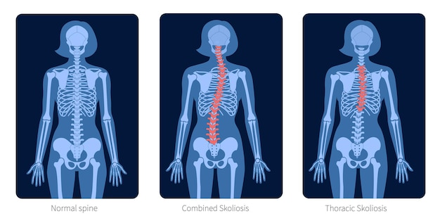 Vector normal spine and types of spine defects. scoliosis in woman body. xray flat vector illustration. backbone, skeleton anatomy in female silhouette. orthopedic poster. medical exam in spinal pain center