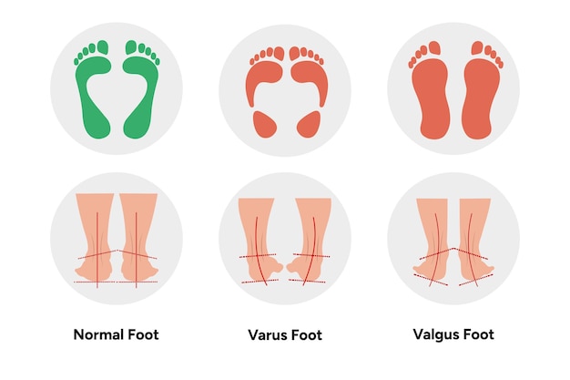 Вектор Нормальная вальгусная и варусная нога