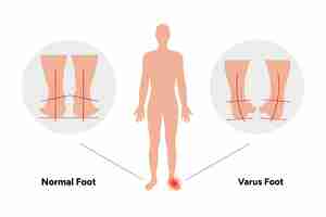 Vector normal and varus foot