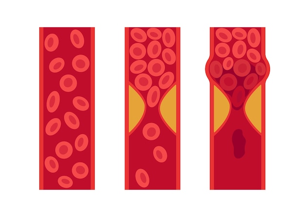 Normale en door cholesterol geblokkeerde slagader bloedstolsel trombus atherosclerotische plaque diepe veneuze trombose