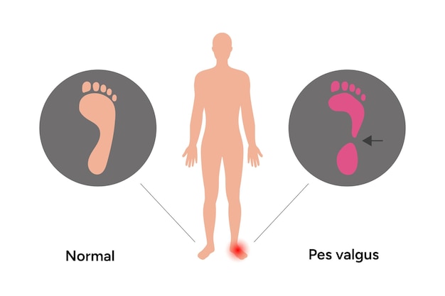 Normale en pes valgus voet