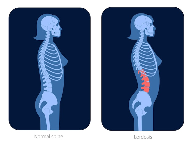 Normale wervelkolom en lordose in het lichaam van de vrouw. XRay platte vectorillustratie. Ruggengraat en skelet anatomie in vrouwelijk silhouet. Orthopedische affiche. Medische banner voor kliniek. Onderzoek in het ruggenmergpijncentrum