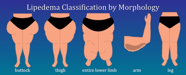 Vector obesity lipedema classification. overweight health issues concept. vector illustration