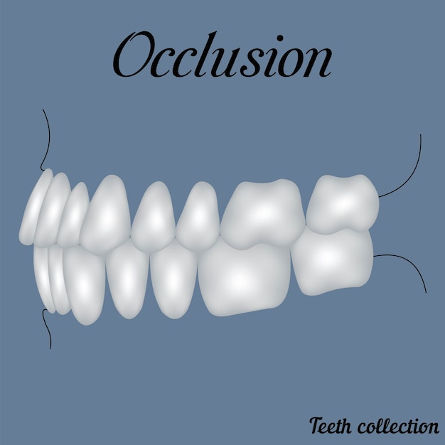 Vector occlusie zijaanzicht