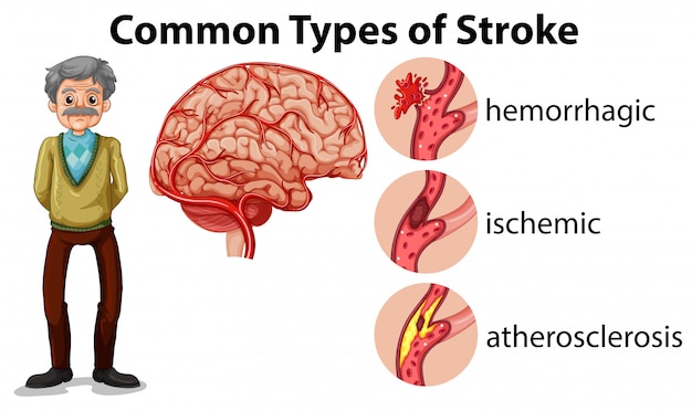 Vector and old man and types of stroke