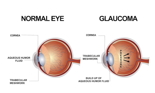Vector oogstructuur anatomie van een oogafwijking glaucoom